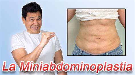mini abdominoplastia-4